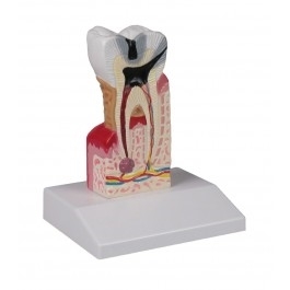 Zdjęcie Model zęba z próchnicą